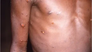 _124838412_22371-monkeypox.jpg