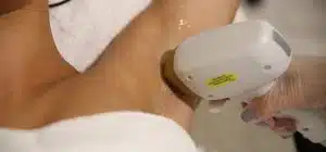 Depilacion-Laser-con-Soprano-Ice-de-Alma-Laser